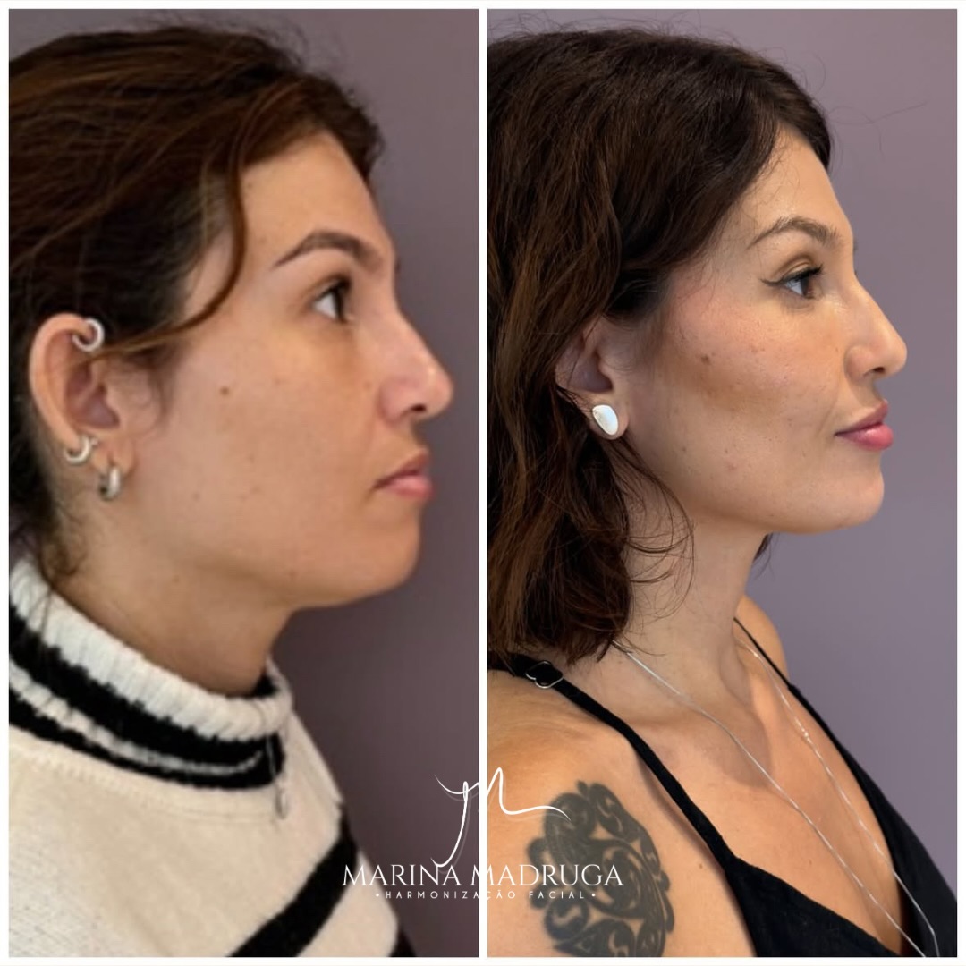 Antes e depois de harmonização facial de perfil