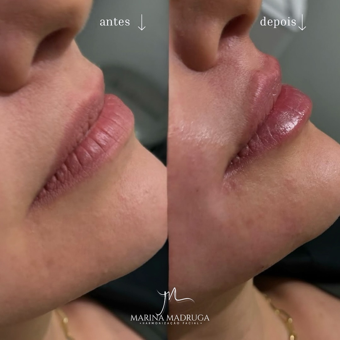 Antes e depois de preenchimento labial