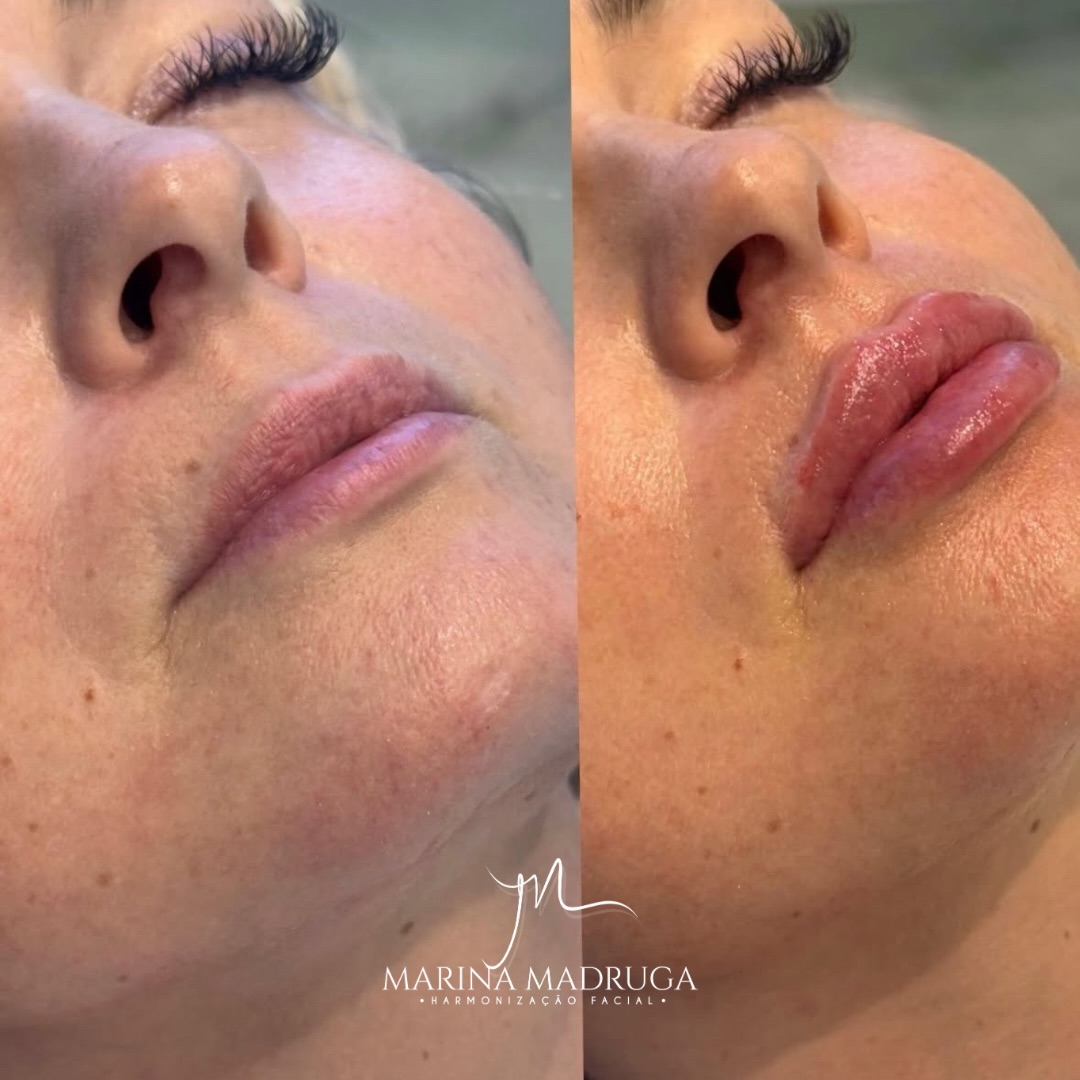 Antes e depois de preenchimento labial